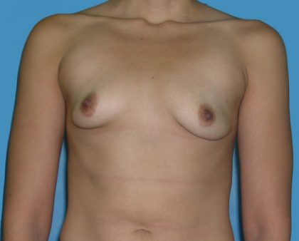 Breast Augmentation Before & After Patient #1416