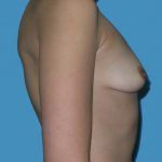 Breast Augmentation Before & After Patient #1416