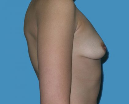 Breast Augmentation Before & After Patient #1416