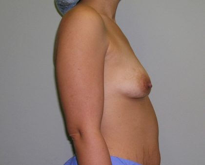 Breast Augmentation Before & After Patient #1453