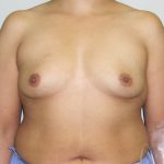 Breast Augmentation Before & After Patient #1600