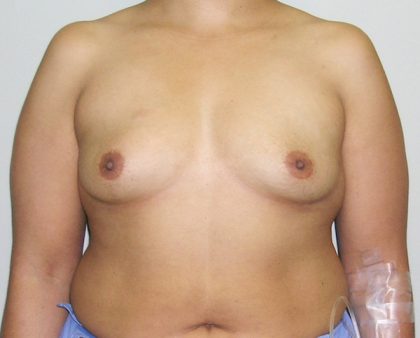 Breast Augmentation Before & After Patient #1600