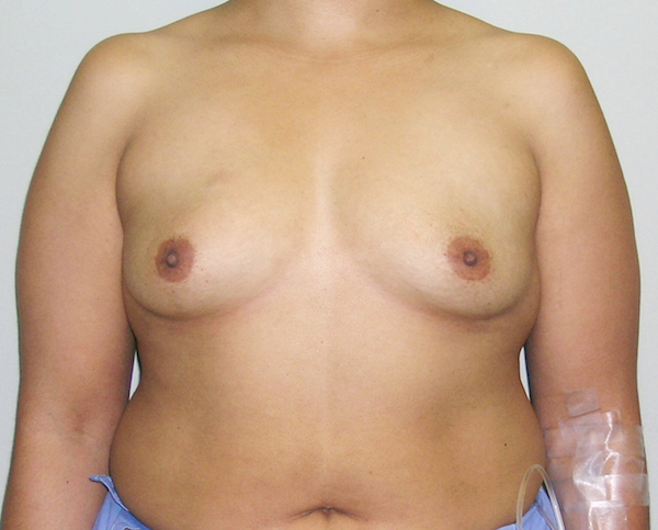 Breast Augmentation Before & After Patient #1600