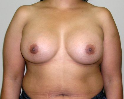 Breast Augmentation Before & After Patient #1600