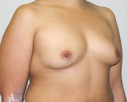 Breast Augmentation Before & After Patient #1600
