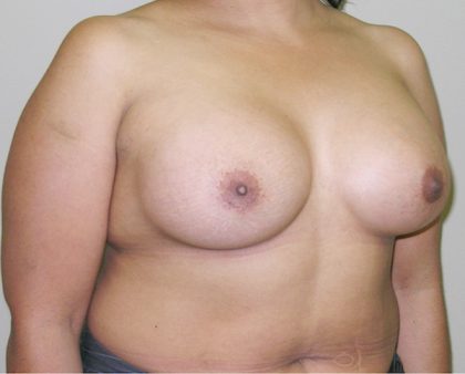 Breast Augmentation Before & After Patient #1600