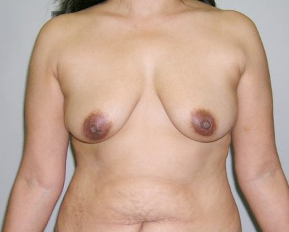 Breast Augmentation Before & After Patient #1642