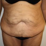 Tummy Tuck Before & After Patient #698