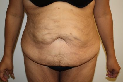 Tummy Tuck Before & After Patient #698