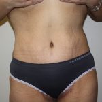 Tummy Tuck Before & After Patient #698