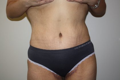 Tummy Tuck Before & After Patient #698