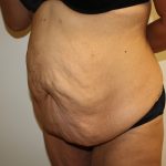 Tummy Tuck Before & After Patient #698