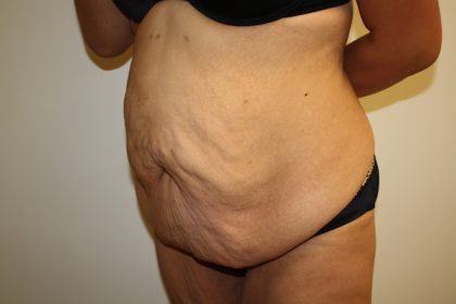 Tummy Tuck Before & After Patient #698