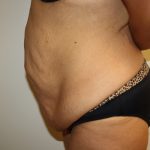 Tummy Tuck Before & After Patient #698