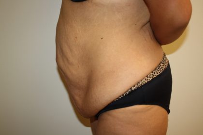 Tummy Tuck Before & After Patient #698