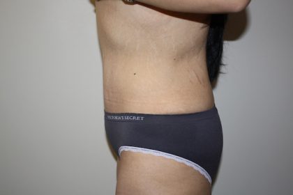 Tummy Tuck Before & After Patient #698