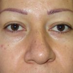 Blepharoplasty Before & After Patient #726