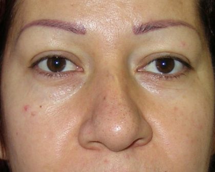 Blepharoplasty Before & After Patient #726