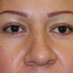 Blepharoplasty Before & After Patient #726
