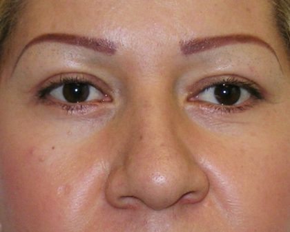 Blepharoplasty Before & After Patient #726