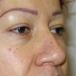 Blepharoplasty Before & After Patient #726