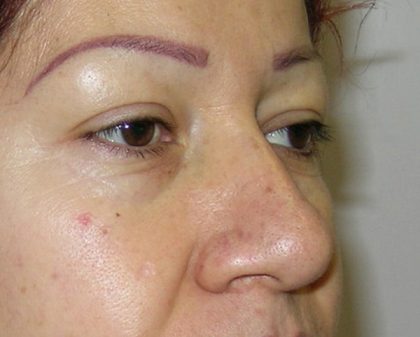 Blepharoplasty Before & After Patient #726