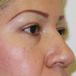 Blepharoplasty Before & After Patient #726