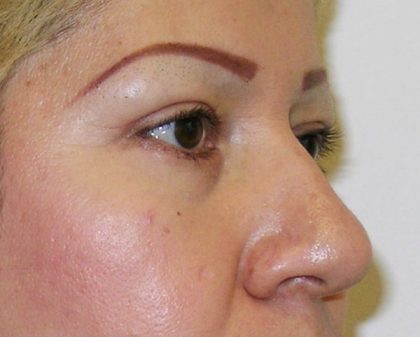 Blepharoplasty Before & After Patient #726