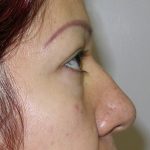 Blepharoplasty Before & After Patient #726