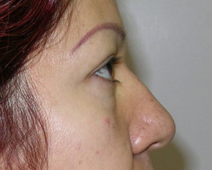 Blepharoplasty Before & After Patient #726