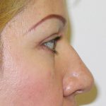 Blepharoplasty Before & After Patient #726