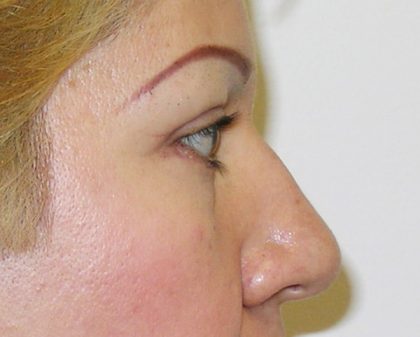 Blepharoplasty Before & After Patient #726