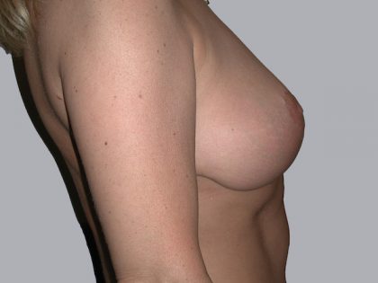 Breast Reduction Before & After Patient #933