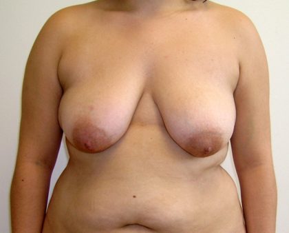 Breast Lift Before & After Patient #841