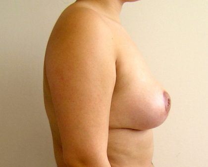 Breast Lift Before & After Patient #841