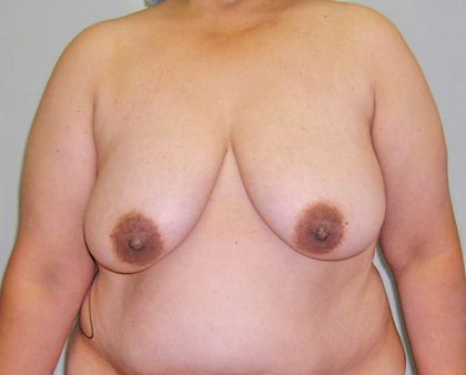 Breast Lift Before & After Patient #848