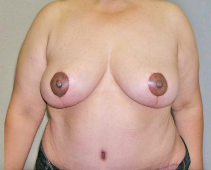 Breast Lift Before & After Patient #848