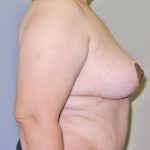 Breast Lift Before & After Patient #848