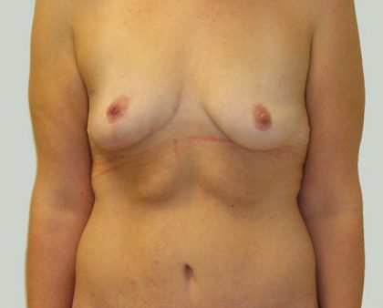 Breast Lift Before & After Patient #869