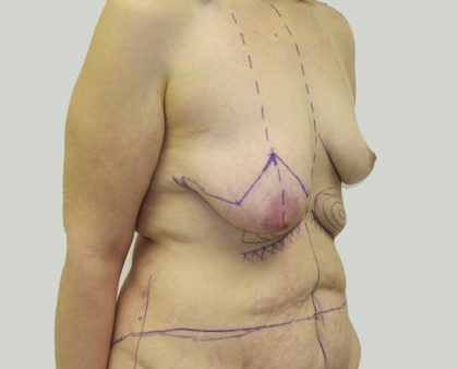 Breast Lift Before & After Patient #869