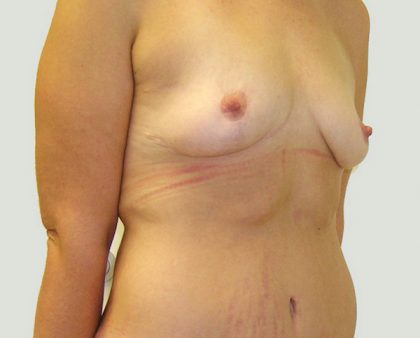 Breast Lift Before & After Patient #869