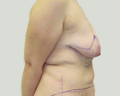 Breast Lift Before & After Patient #869
