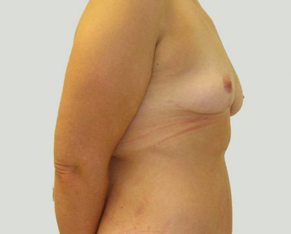 Breast Lift Before & After Patient #869