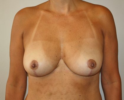 Breast Revision Before & After Patient #1038