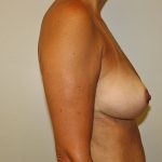 Breast Revision Before & After Patient #1038