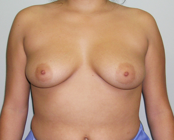 Breast Augmentation Before & After Patient #1537