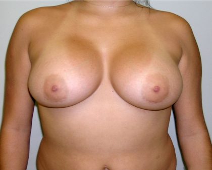 Breast Augmentation Before & After Patient #1537