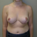 Breast Reduction Before & After Patient #926