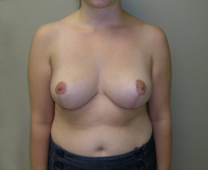 Breast Reduction Before & After Patient #926