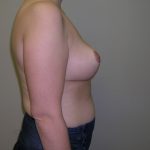 Breast Reduction Before & After Patient #926